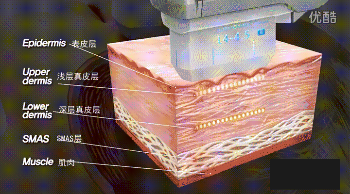 科普 ：「黄金超声炮」熟龄肌抗衰的秘密武器”
