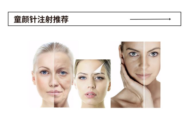 科普：「童颜针」PLLA注射推荐指南
