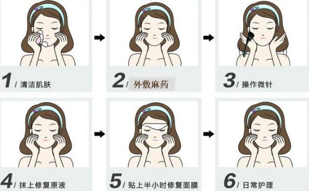 科普：「微针疗法」新手扫盲攻略