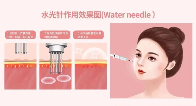 科普：「水光针」实用版使用攻略