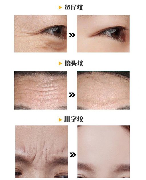 科普：「肉毒素」应用及注意事项