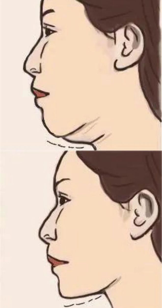 科普：「肉毒素」应用及注意事项