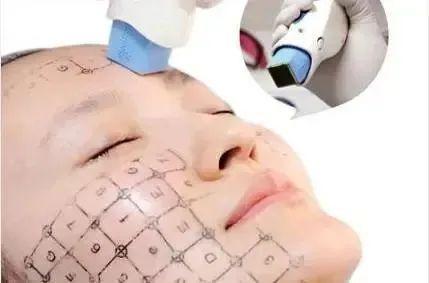 科普：「热玛吉」 抗衰首选干货指南