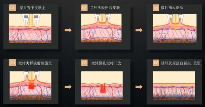 科普：「黄金微针」美肤神器面部应用指南
