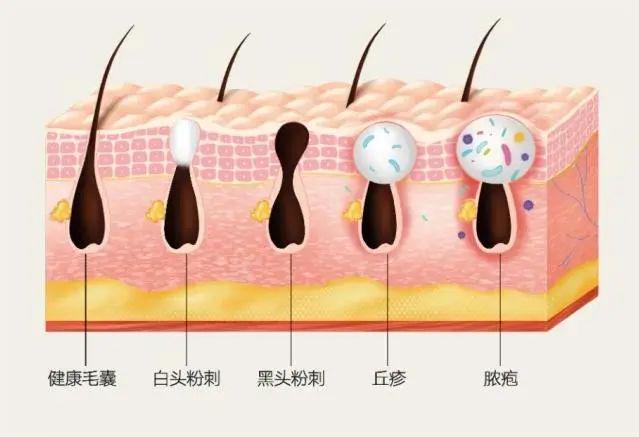 科普：「红蓝光」痘肌护理的天命好物
