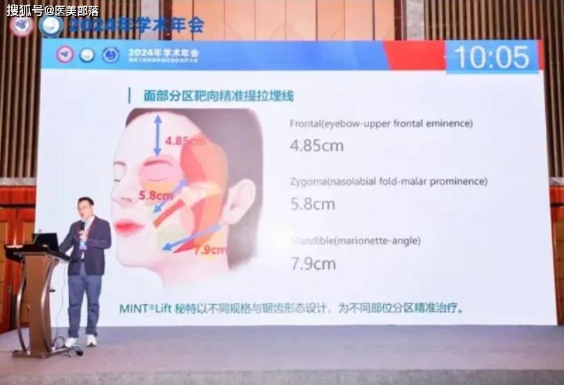 MINT®Lift：秘特「筋膜支架」技术，突破传统「线材」局限