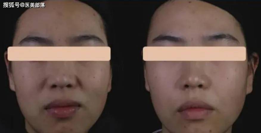 佰仁医疗 | 旗下佰荟「胶原蛋白水光针」获国家药监局注册受理