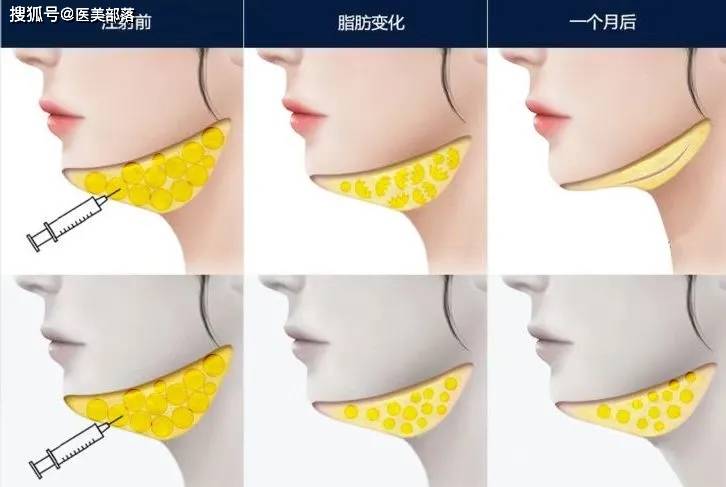 科笛集团 | 旗下「双下巴」溶脂针「CU-20401」完成II期临床试验