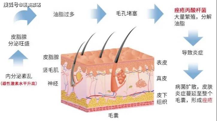 科笛生物 | 全球首个「外用米诺环素」获批，开创「痤疮治疗」新选择