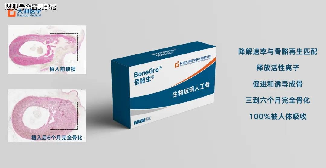 重磅 | 国内「羟基磷灰石」三证获批，再生医美进入「白热化」竞争时代 