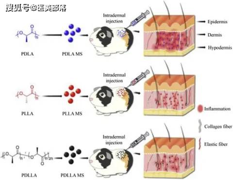 重磅丨医美材料「聚乳酸PLA」强势进阶，「赋能医美」新革命