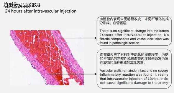 重磅 | 医美新宠「PLA材料」的应用，「安全与效果」的双重考验