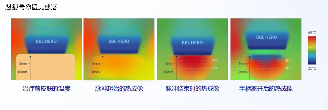 BBL HERO | 技术革新「不止嫩肤」，开创「智能抗衰」新时代