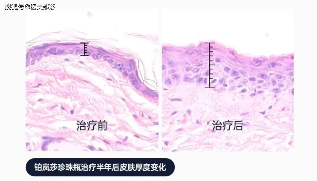 寻美之旅 | 「铂岚莎」全球独有纳米钙微球技术，开启「屏障再生」医美新纪元 