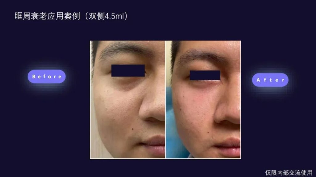 斐缦生物 | 二类「佛曼」严重侵权，认准三类「弗缦®」胶原蛋白