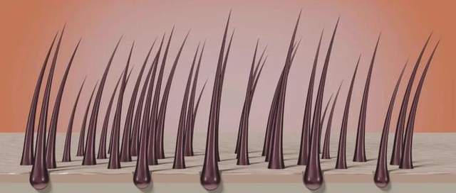 科笛生物 | 全球「首个且唯一」外用「非那雄胺喷雾剂」获批上市