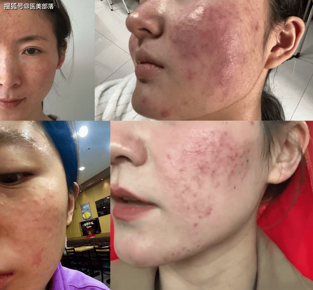 重磅 | 「居家水光」频发烂脸现象，「美团医美」联合头部机构启动水光公益计划