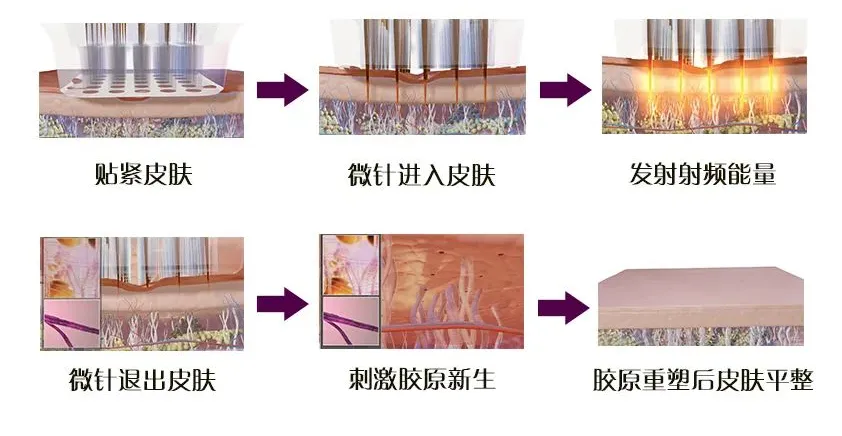 重磅 | 当黄金微针遇上「金蔓佳®」，开启「无痛焕肤」新体验